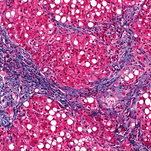 Фиброз тканей. Цирроз печени гистология. Алкогольный гепатит гистология. Мелкоузловой цирроз печени гистология. Алкогольный фиброз печени гистология.
